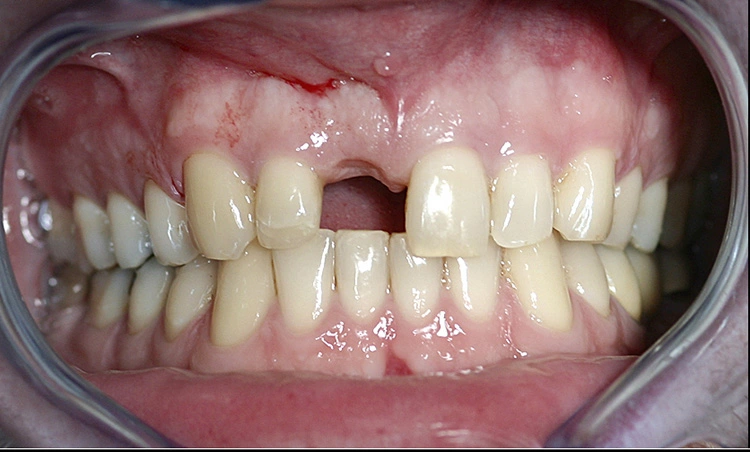 Abb. 9: Die gingivale Situation vor dem Einsetzen des Abutments im Jahr 2011.