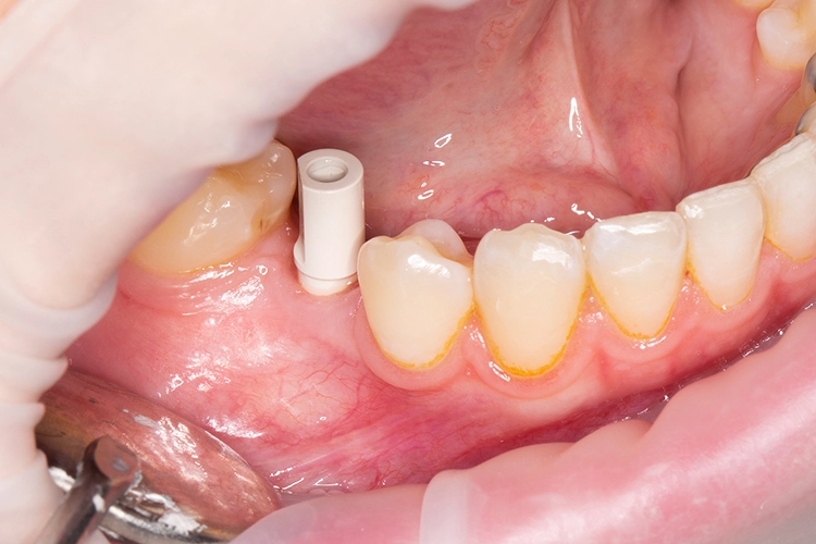 Abb. 9: Das Scan-Abutment wurde für die Restaurationsplanung auf dem Implantat platziert.
