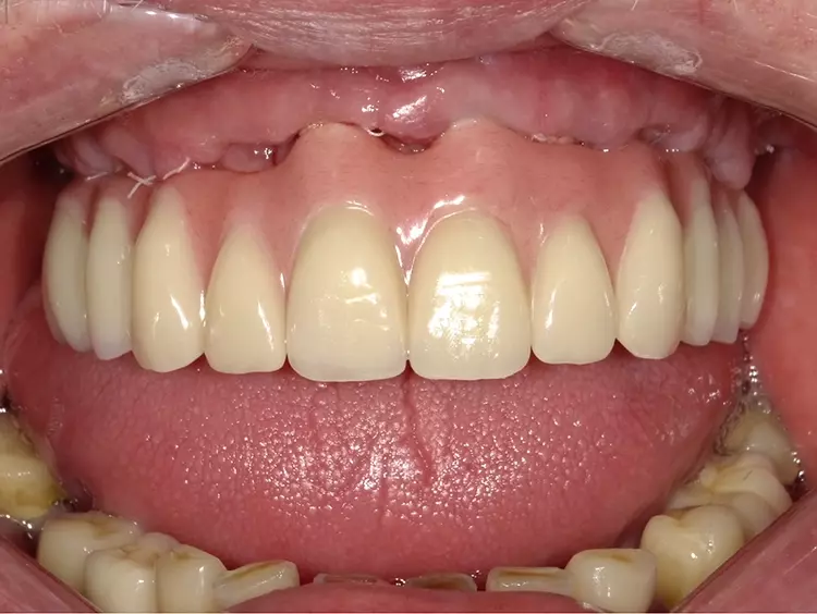 Abb. 8: Situation nach Abheilung mit eingegliederter provisorischer Brücke.