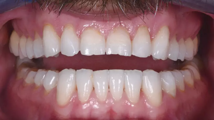 Abb. 9: Behandlungsphase 1 von 2: nach Abschluss mit Invisalign®.