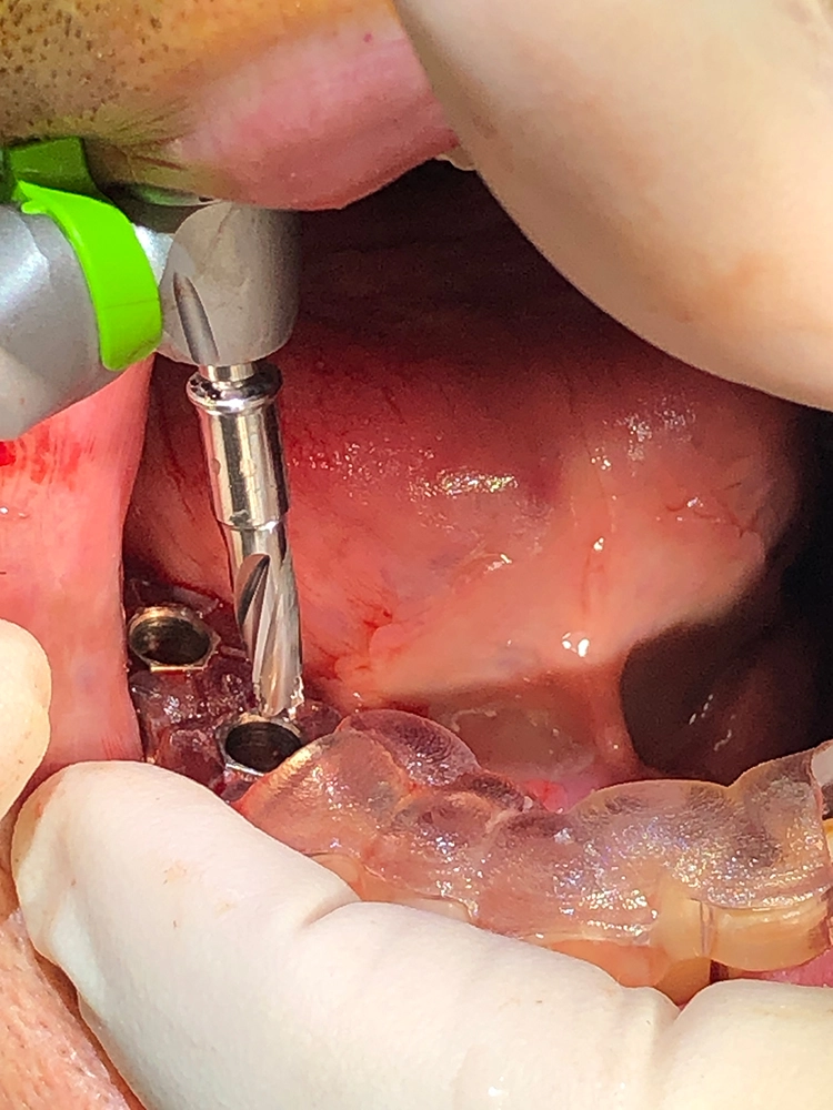 Abb. 9: Finale Bohrung auf Implantatstärke.