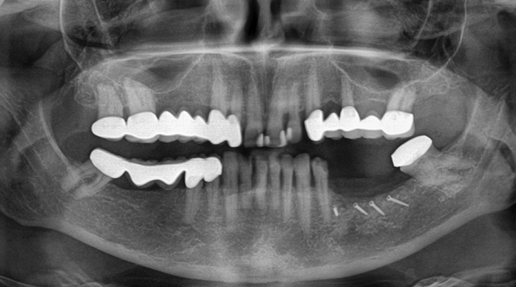Abb. 9: Das postoperative Röntgenbild zeigt den augmentierten Bereich im 3. Quadranten.