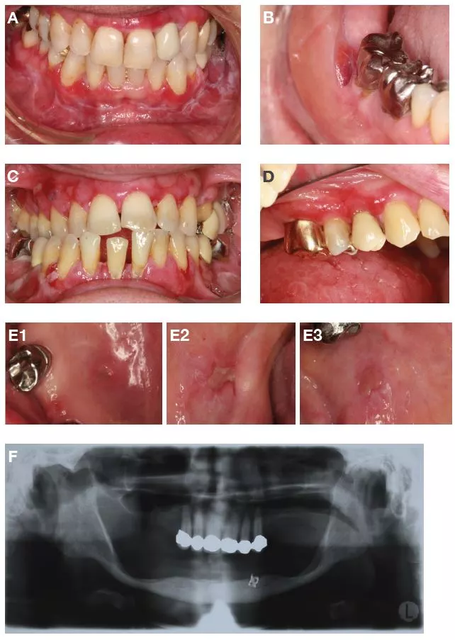 Abb. 2: Klinische Beispiele für relevante orofaziale Erkrankungen.
A: Ausgeprägter oraler Lichen planus.
B: Bullöses Pemphigoid.
C: Pemphigus.
D: Erosiver oraler Lichen planus im Oberkiefer und Kombination von Lingua plicata und Lingua geographica.
E1, E2, E3: Drei verschiedene Läsionen eines oralen Lupus erythematodes bei ein und demselben Patienten.
F: Ausgedehnte Atrophie des Unterkieferknochens mit Resten eines Implantats in regio 33.