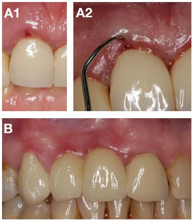Abb. 3: Klinische Beispiele für mechanische Irritationen.
A1, A2: Insuffizienter Randschluss eines FZ und persistierende Gingivitis an Zahn 11.
B: FZ mit massiven und traumatisierenden Zwischengliedern und persistierender Gingivitis in regio 11/12.