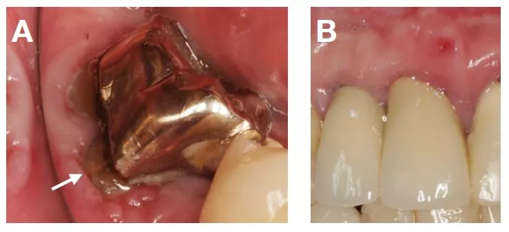 Abb. 4: Klinische Beispiele für relevante dentale Befunde.
A: Zahn- und Kieferschmerzen aufgrund einer Wurzelfraktur an Zahn 47.
B: Zahnschmerzen, Geschmacksstörungen und Druckgefühl im Bereich der oberen Schneidezähne aufgrund einer Fistel und eines intraossären parodontalen Defekts an Zahn 11.