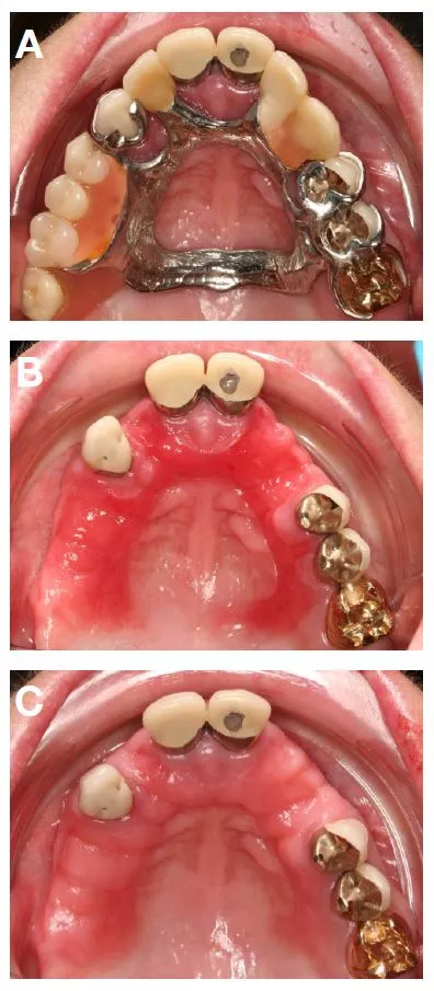 Abb. 5: Klinisches Beispiel für einen relevanten plaquebedingten Befund: Patientin mit Prothesenstomatitis, die sich als HZ-kongruente Rötung des Gaumens manifestierte (A,B) und nach Abklingen durch konsekutive antibakterielle und antimykotische Therapie mit Chlorhexidin-Mundspülung (0,2%) und Amphotericin B für jeweils eine Woche (C).