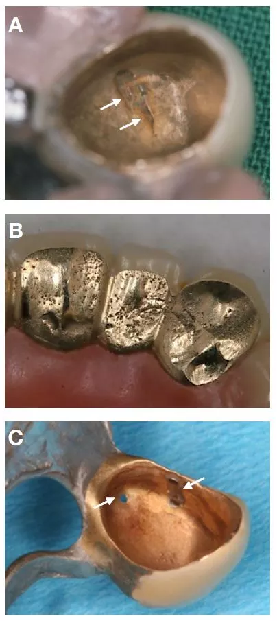 Abb. 6: Klinische Beispiele für relevante Verarbeitungsfehler.
A: Korrosionsstelle in einer Außenteleskopkrone.
B: Lunker an Außenteleskopkronen.
C: Außenteleskopkrone mit Perforation und großer Lötstelle.