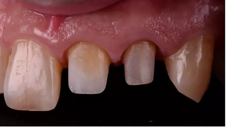 Abb. 11: Zustand nach Wurzelstiftkernaufbau und subgingivaler Präparation in
regio 21 und 22.