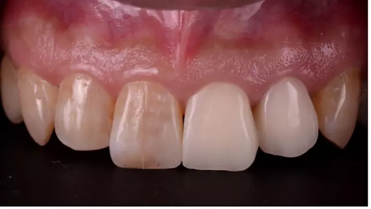 Abb. 12: Provisorische Versorgung.