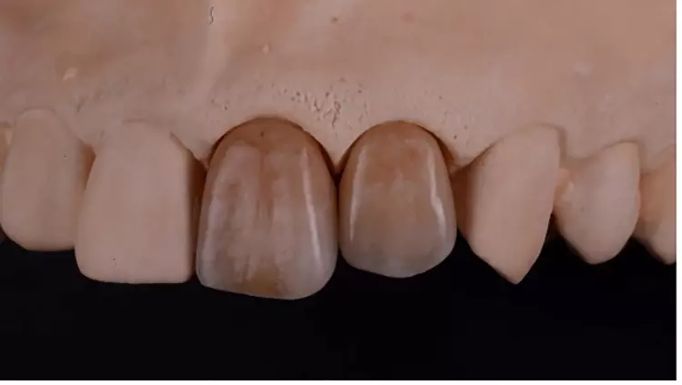 Abb. 14: Vollkeramische Kronen mit Individualisierung in Kombination aus
Schicht- und Maltechnik.