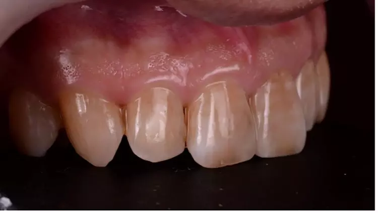 Abb. 16: Zustand nach adhäsiver Befestigung.