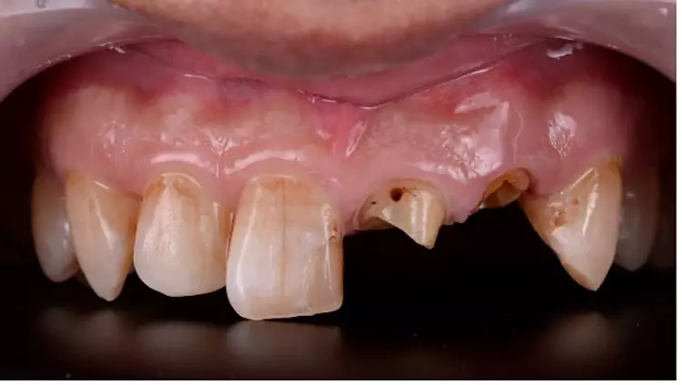 Abb. 2: Zustand nach Kronenabnahme regio 21.