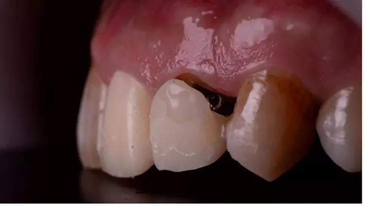 Abb. 3: Zustand nach Wurzelkanalbehandlung an 21 und 22 sowie provisorischer
Versorgung.