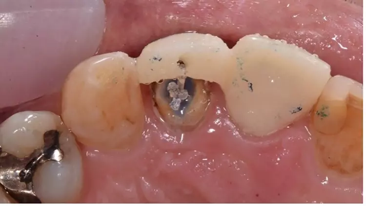 Abb. 4: Anschlingung zur Extrusion mittels Gummizuges von Zahn 22 am
Provisorium.