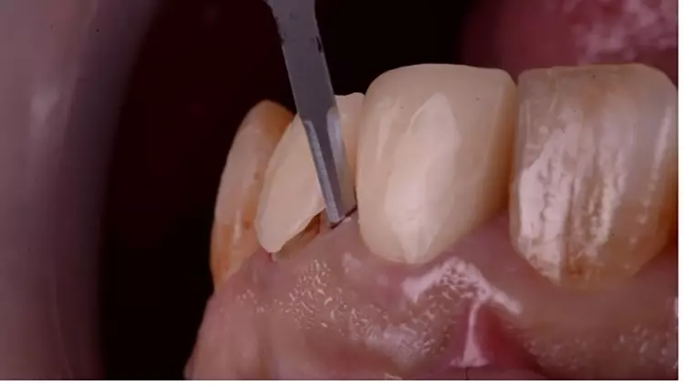 Abb. 5: Sulkuläre Schnittführung zur chirurgischen Kronenverlängerung.