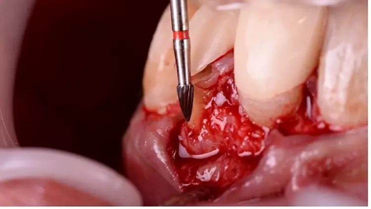 Abb. 6: Wurzelglättung mit Hartmetallfräse.