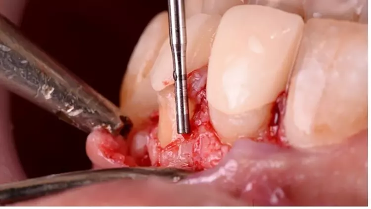 Abb. 7: Verlagerung der Knochenkante mit stirnseitig verzahnter Fräse.