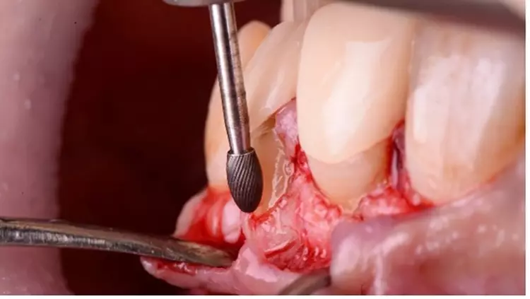 Abb. 8: Abrunden der Knochenkanten mit feiner Fräse.