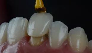 Der AGK Forschungspreis fördert die Erweiterung der Evidenzbasis zu den Einsatz- und Verarbeitungsmöglichkeiten moderner dentaler Werkstoffe in der restaurativen Zahnheilkunde und Prothetik.