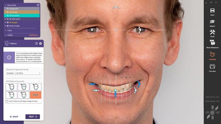 Mit der neuen Version von DentalCAD 3.0 Galway führt exocad KI-Technologie für seinen Smile Creator ein.