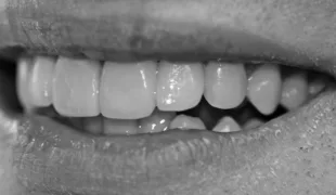 Harmonisierte Lachlinie des Patienten.