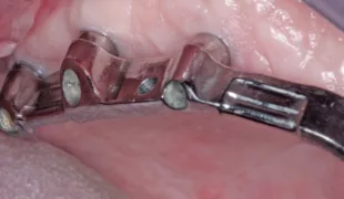 Durch CAD/CAM-Techniken ist die Steg-Riegel-Versorgung eine attraktive Alternative zur Versorgung des unbezahnten Oberkiefers auf Implantaten.
