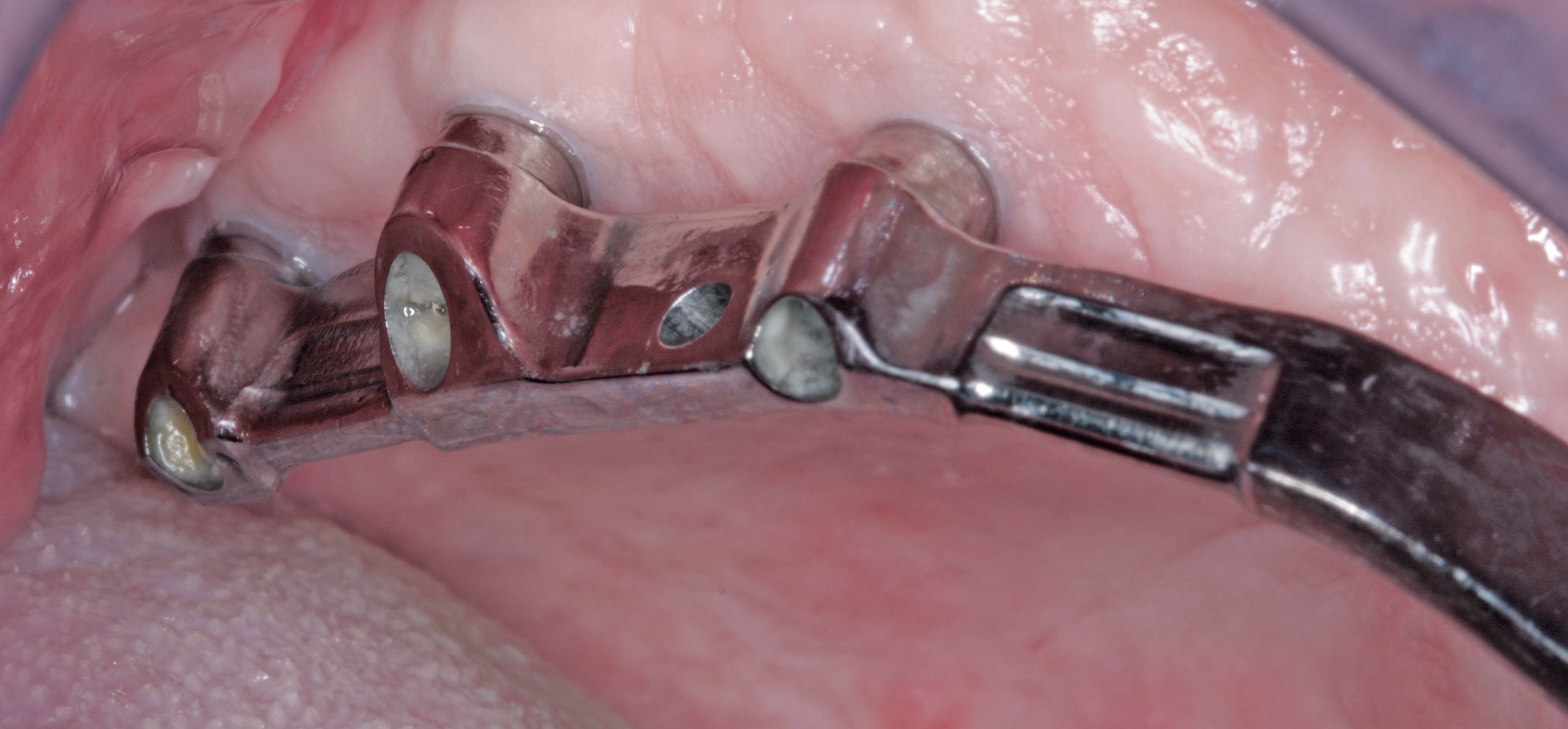 Durch CAD/CAM-Techniken ist die Steg-Riegel-Versorgung eine attraktive Alternative zur Versorgung des unbezahnten Oberkiefers auf Implantaten.