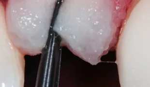 Einbringen von Geistlich Fibro?Gide® in den gewünschten Bereich.