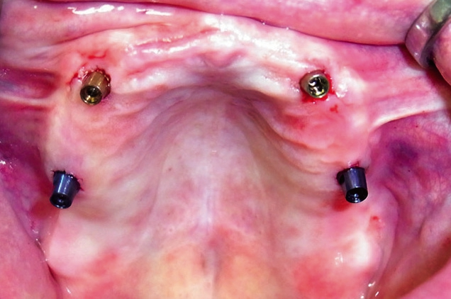 Abb. 1: Transgingivale Implantation, full guided mit ExpertEase™/XiVE.