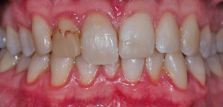 Abb. 1: Frontalansicht mit deutlich verfärbtem, endodontisch versorgtem Zahn 12 und dezenter Gingivitis generalisata.