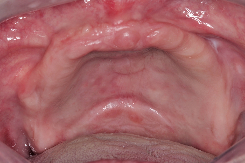 Abb. 1: Ausgangssituation intraoral, zahnloser Oberkiefer.