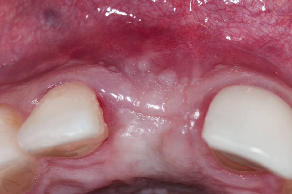 Abb. 1: Ausgangssituation (okklusal): fehlender mittlerer Schneidezahn rechts mit labialem Weichgewebemangel drei Monate nach Implantatinsertion.