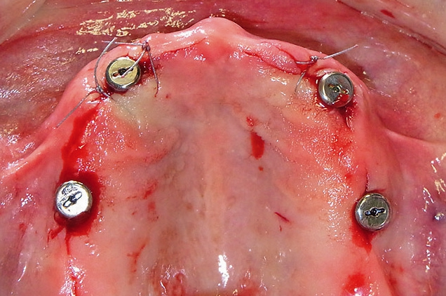 Abb. 3: Freilegung 3 Monate nach Implantation.
