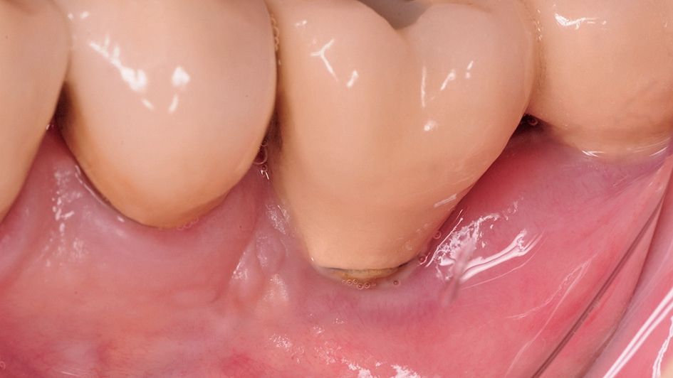 Abb. 3: Klinisches Bild am Tag der Erstvorstellung mit Beschwerden am Implantat 36.