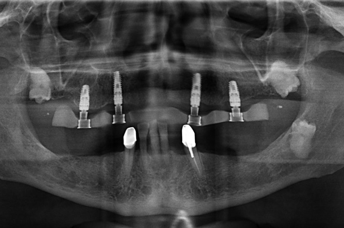 Abb. 4: OPG post OP-Kontrolle.