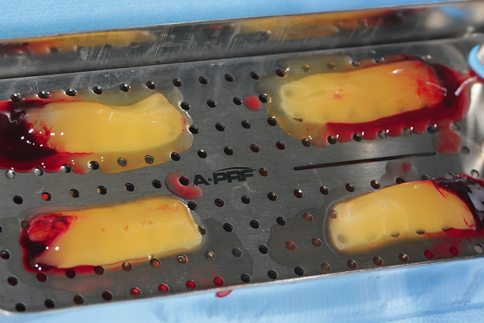 Abb. 5: A-PRF Membranen unmittelbar nach Zentrifugation bei 8 Minuten und 1.300 U/min.