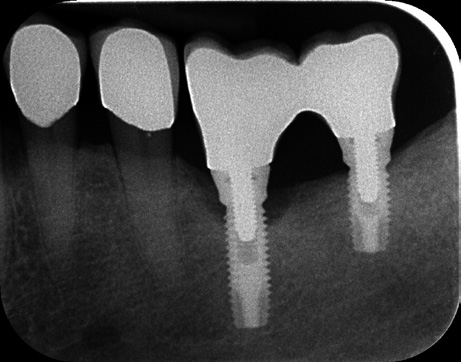 Abb. 5: Röntgenbild Mai 2017: Es zeigt sich ein deutlicher krestaler Knochendefekt um das Implantat regio 36.