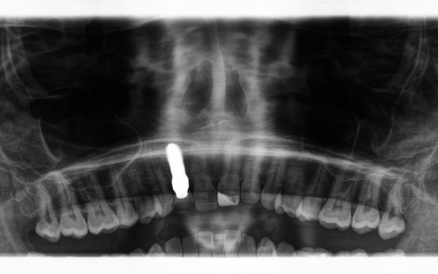 Abb. 7: Postoperatives digitales OPTG zeigt die prothetisch korrekte Positionierung des Implantates.
