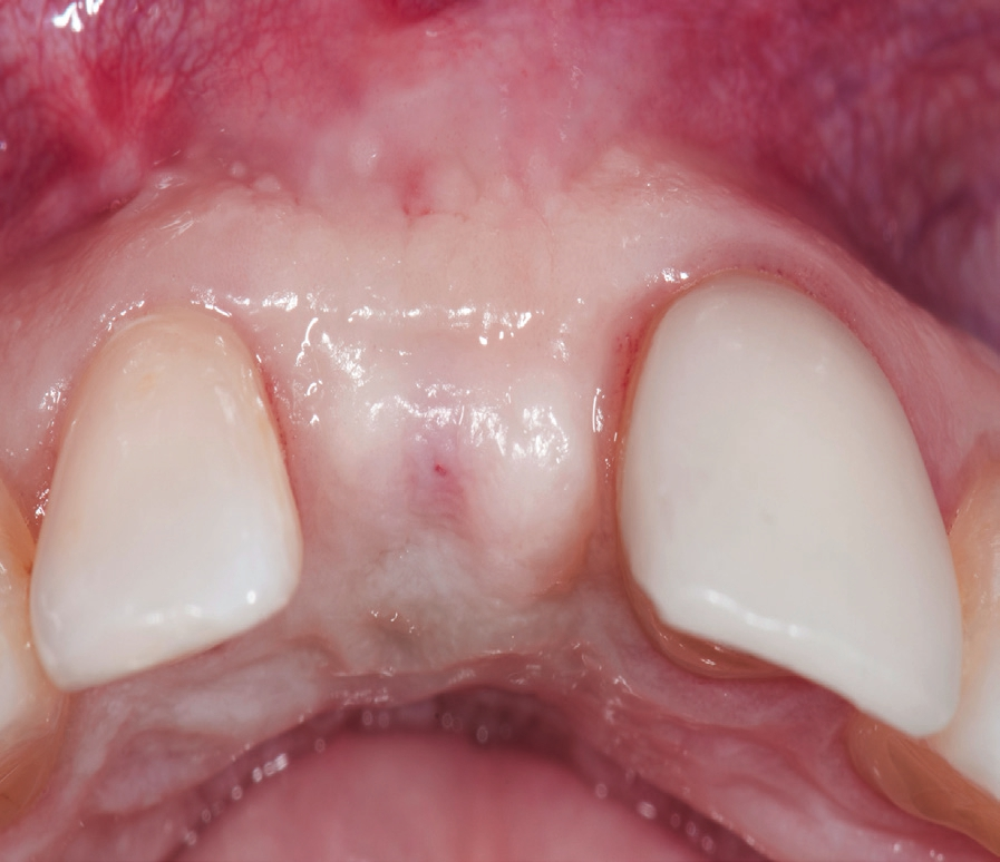 Abb. 8: Situation 4 Monate nach Weichgewebeaugmentation.