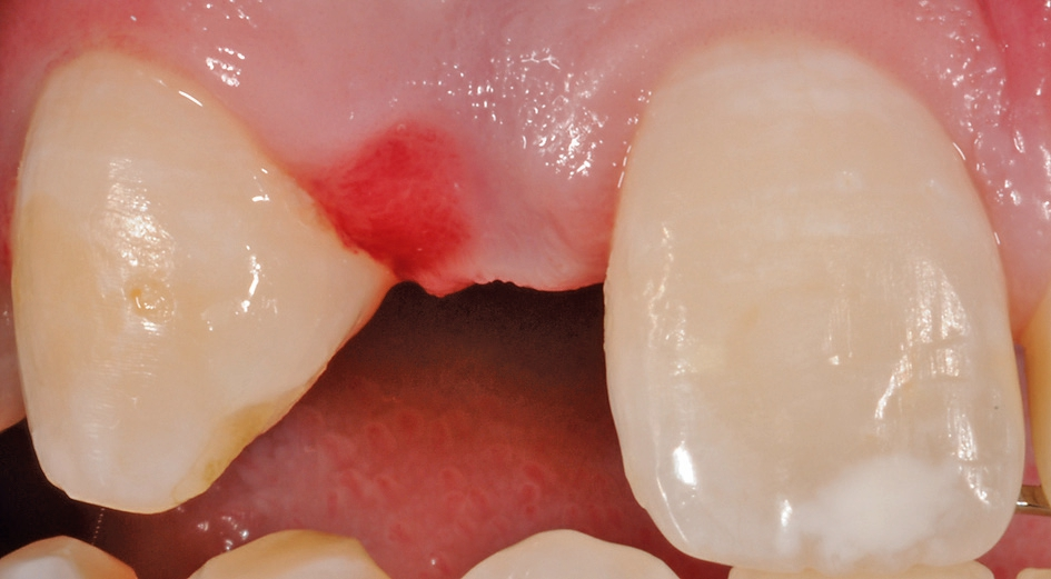 Abb. 8: Detailansicht Region 12 vor Implantation.