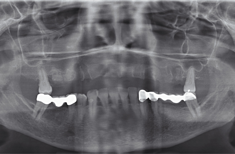 Abb. 10: Zeit nach Extraktion und indirektem Sinuslift und B.O.C. (Socket Preservation).