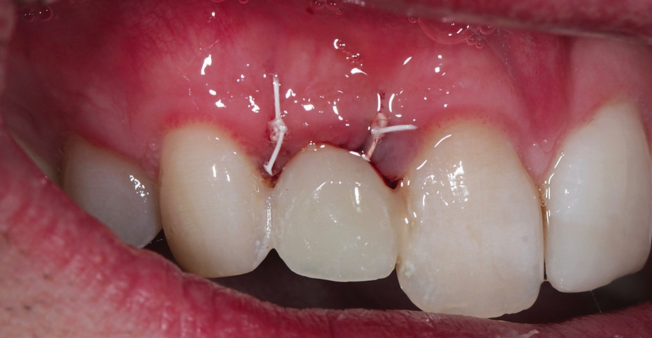 Abb. 10: Eingliederung des Acrylat-Provisoriums, welches in Non-Okklusion ist.
