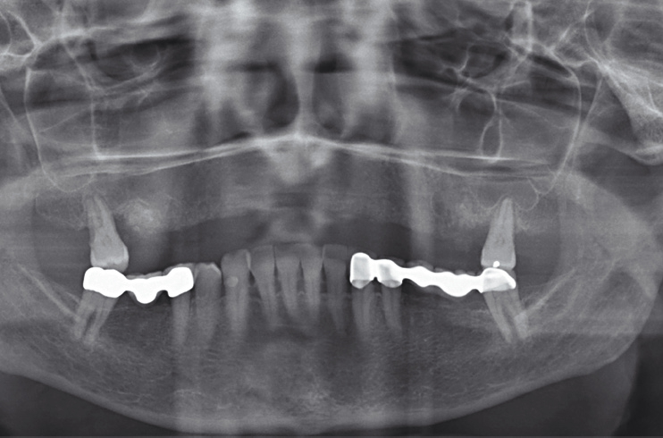 Abb. 11: OPG-Kontrolle nach externem Sinuslift und Bone Splitting beidseitig (8 Wochen post Ex).