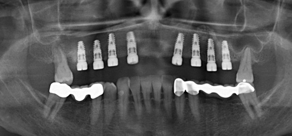Abb. 15: OPG-Kontrolle nach Freilegung (+ 5 Monate nach Extraktionstherapie).
