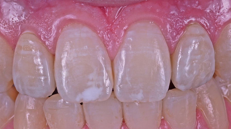 Abb. 13: Zustand nach drei Jahren mit beginnender Rezession des Weichgewebes am Implantat 12.