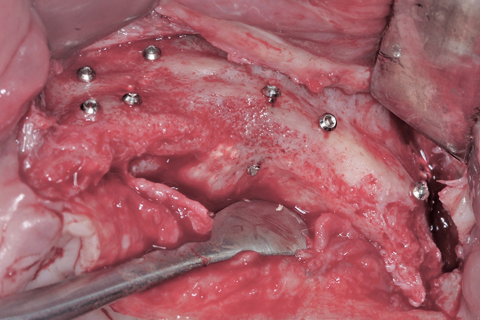 Abb. 14: Zustand nach 3 bis 4 Monaten Ausheilung. Es zeigt sich ein gut revaskularisierter Knochen ohne Resorption.