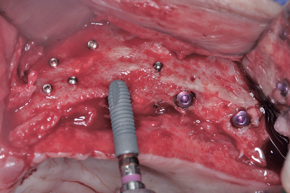 Abb. 15: In den neu aufgebauten Knochen können sechs Astratech Implantate (Dentsply Sirona) inseriert werden.