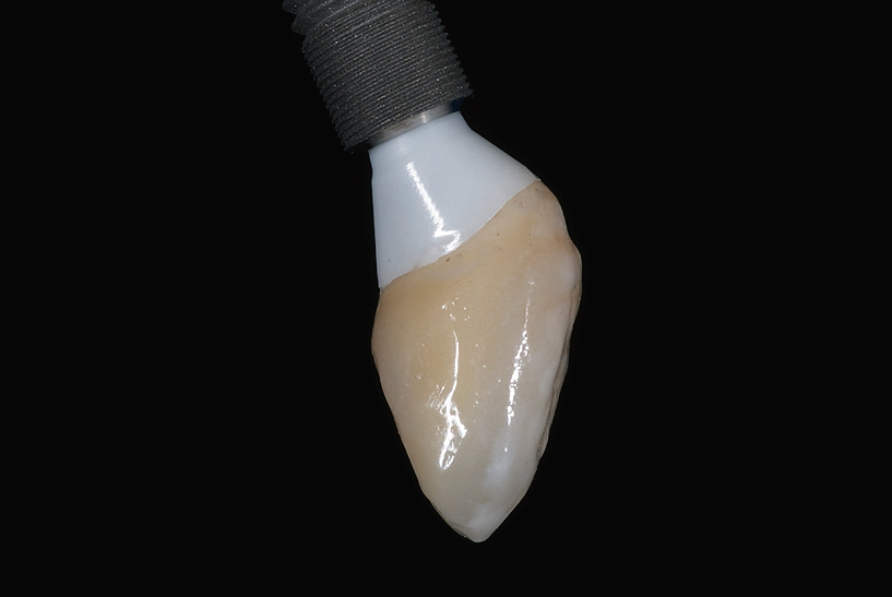 Abb. 15: Implantat mit Abutment und Krone.