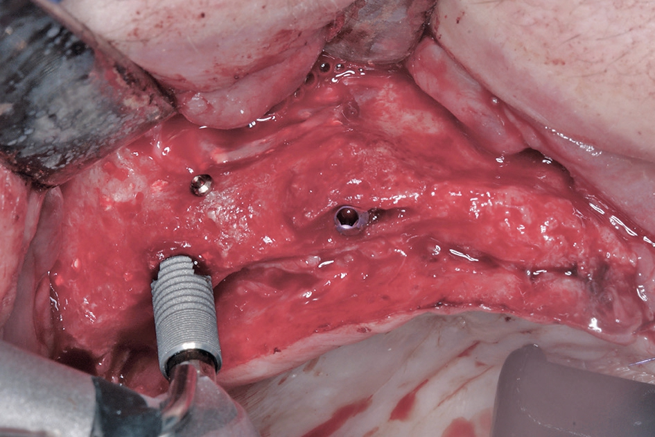 Abb. 17: Es werden die restlichen drei Implantate (Astratech, Dentsply Sirona) inseriert.