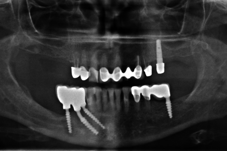 Abb. 24: Ausgangssituation Implantatbruch im 4. Quadranten alio loco.
